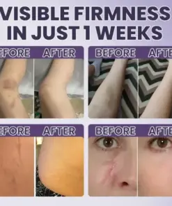 𝑴𝑹𝑬𝑽𝑩𝑺𝑰𝑵® Bruise Recovery Cream