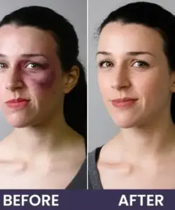 𝑴𝑹𝑬𝑽𝑩𝑺𝑰𝑵® Bruise Recovery Cream